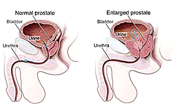 Image of enlarged prostate