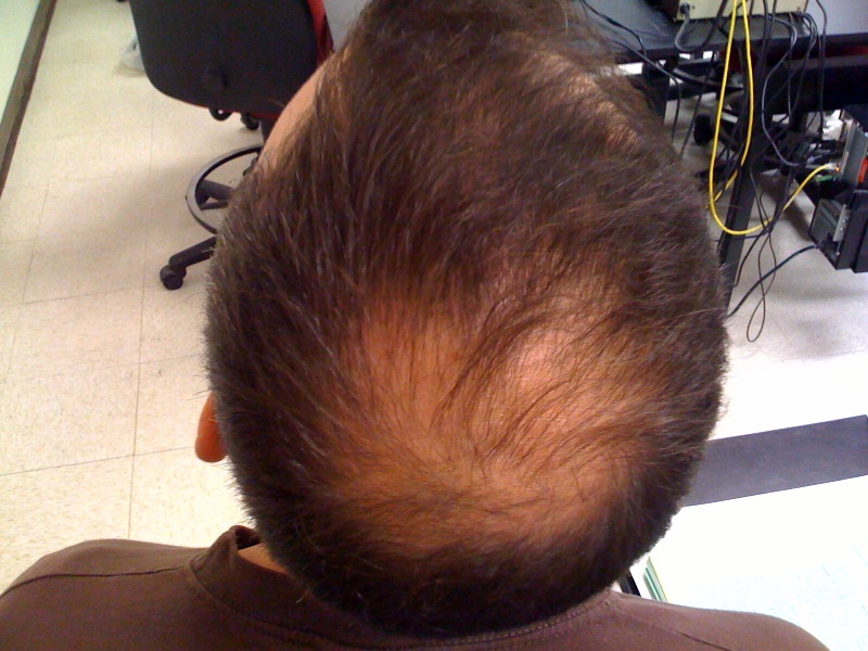 Worried about going bald? There are ways to reverse hair loss in men