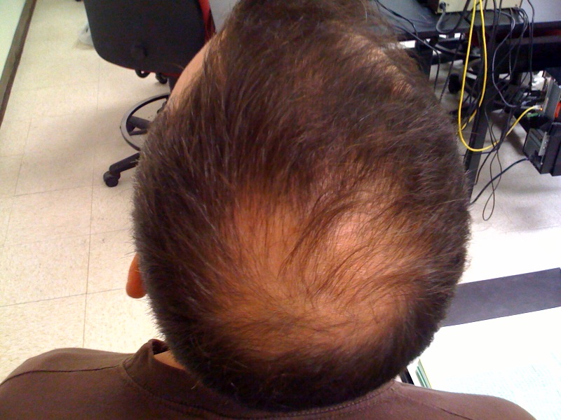 Platelet Rich Plasma Treatment for hair loss 