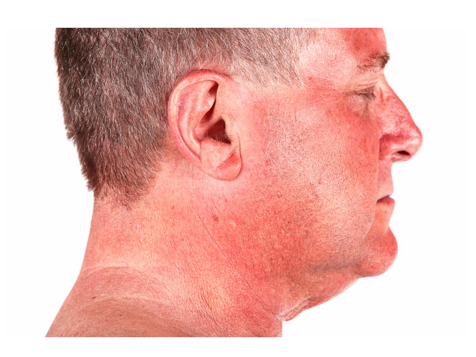 sun damage in middle aged man